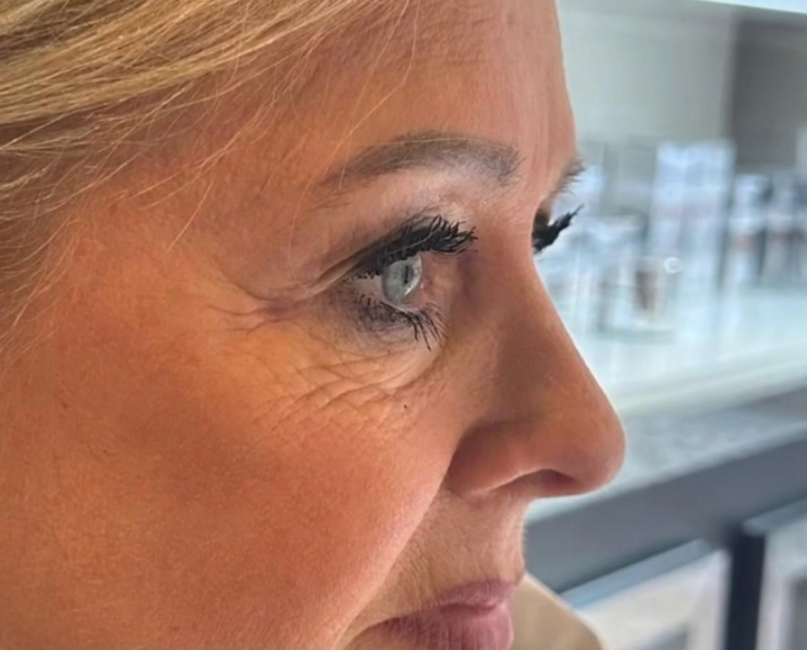 Gesichtsprofil einer Kundin vor dem RF-Needling bei Skin Aesthetics Lüneburg