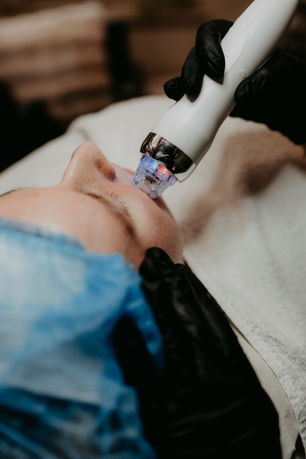 RF-Needling Behandlung im Gesicht bei Skin Aesthetics Lüneburg